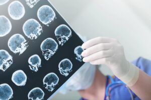 brain injury lawyer Lake Worth, FL