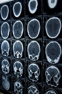 catastrophic injury lawyer in Delray Beach, FL